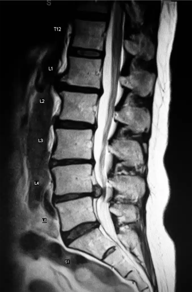 Image of Spinal Decompression Therapy for Herniated Discs with lumbar spine MRI showing a herniated disc